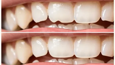 composite-bonding-in-blackpool:-a-quick-and-affordable-solution-for-a-beautiful-smile
