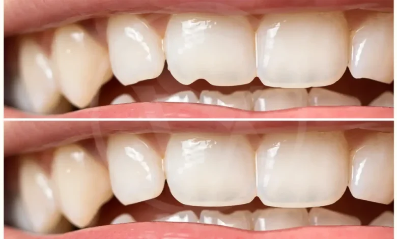 composite-bonding-in-blackpool:-a-quick-and-affordable-solution-for-a-beautiful-smile